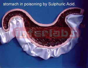 Stomach in a case of poisoning by sulphuric acid
